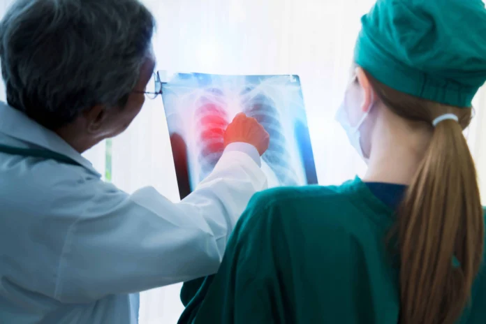 Diagnóstico temprano de cáncer pulmonar.